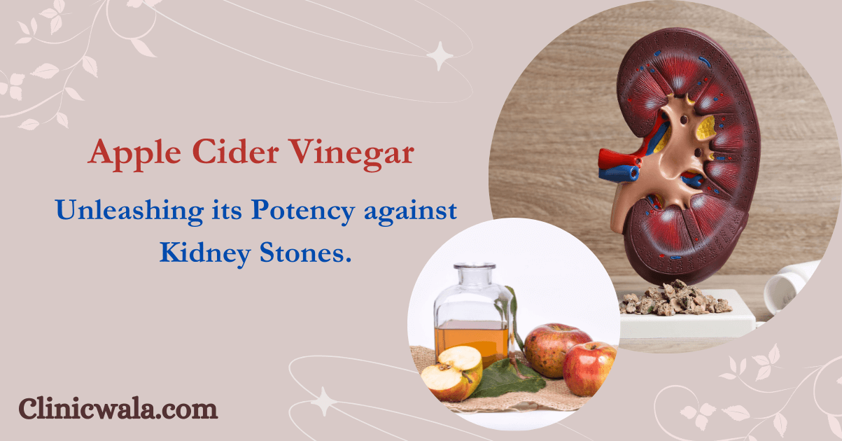 Naturally Combat Kidney Stones with the Benefits of Apple Cider Vinegar
